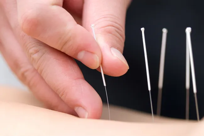 Acupuncture treatment can compliment chiropractic adjustments. 
