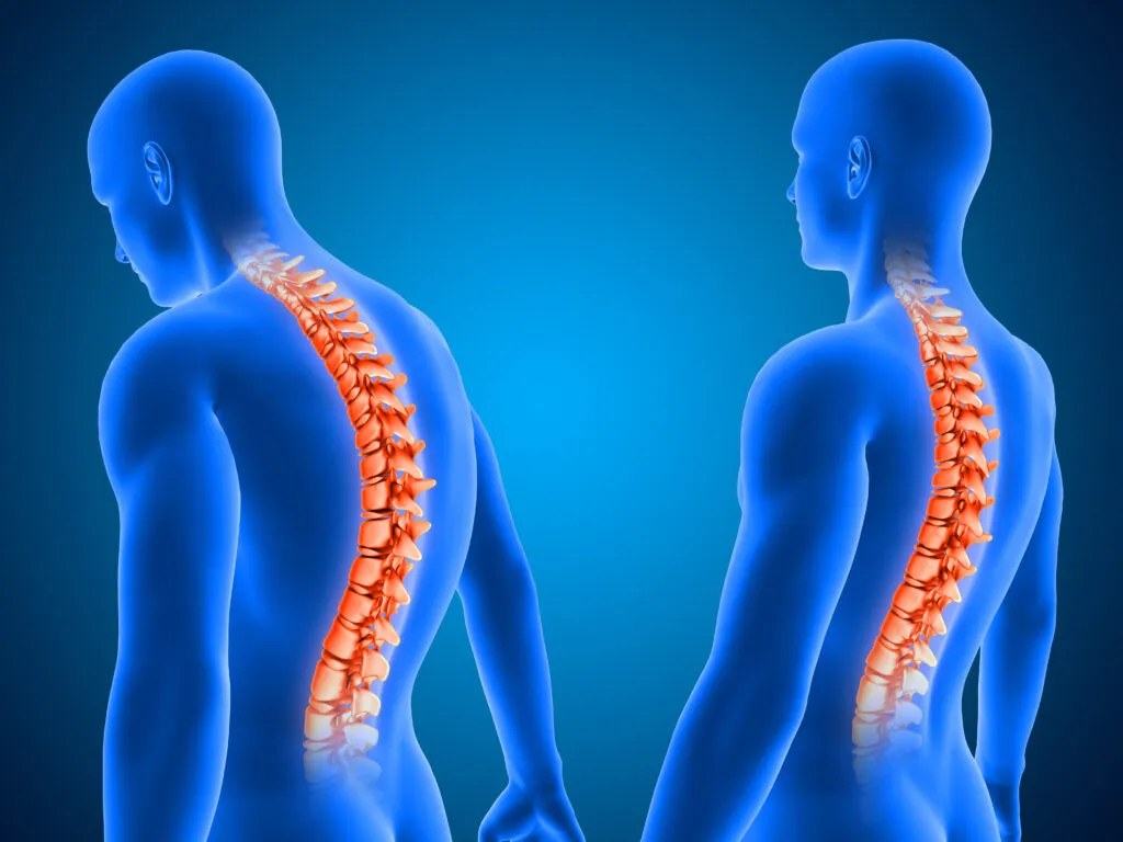 3d Render Showing Correct Poor Posture With Spine Highlighted